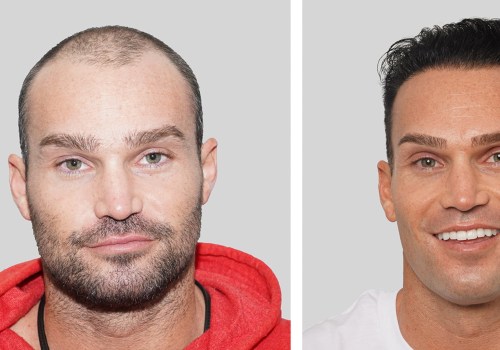 Does hair restoration actually work?