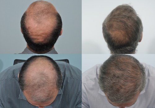 Are hair transplants really permanent?
